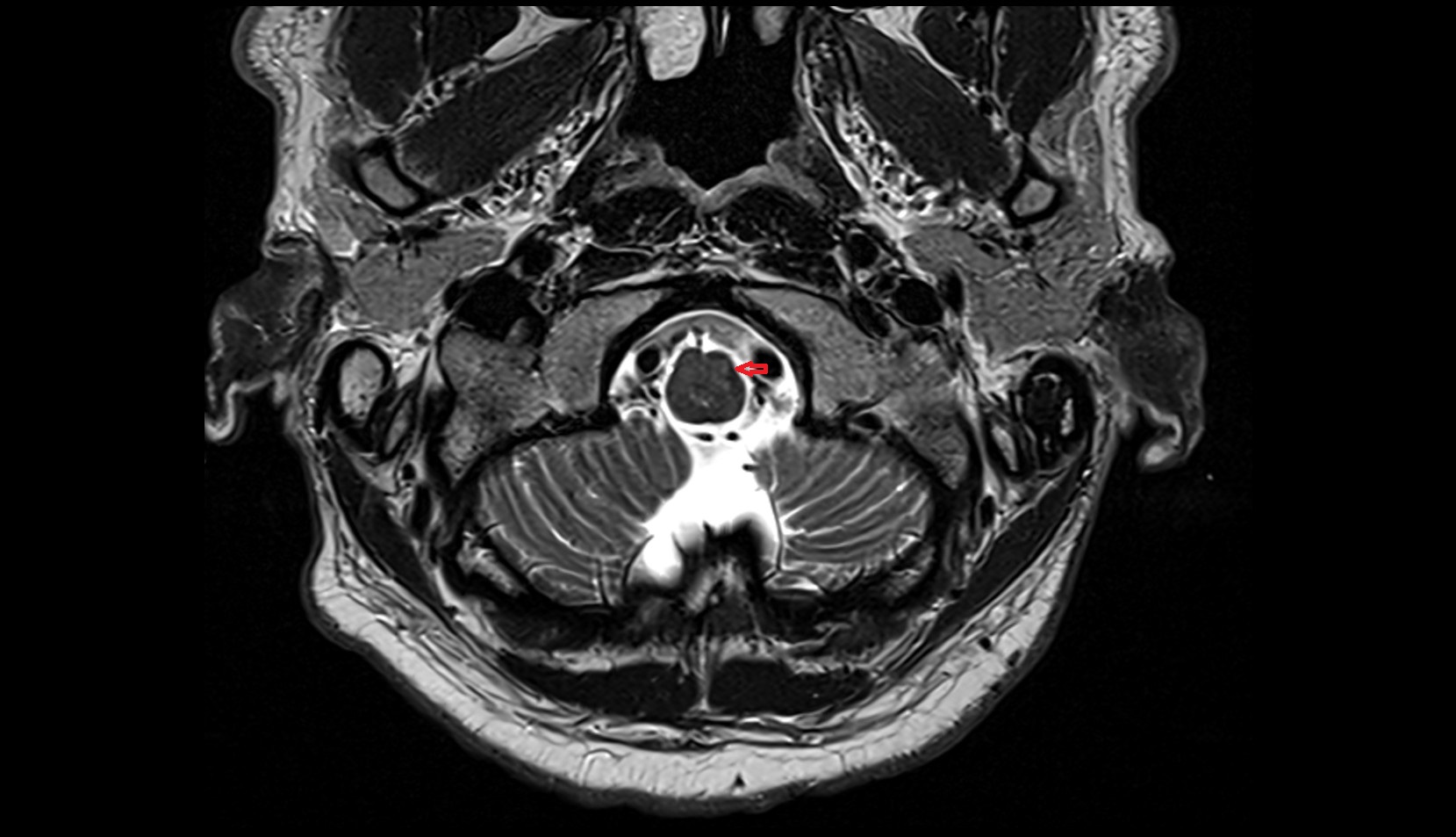Ventrolateral sulcus MRI 3T axial image