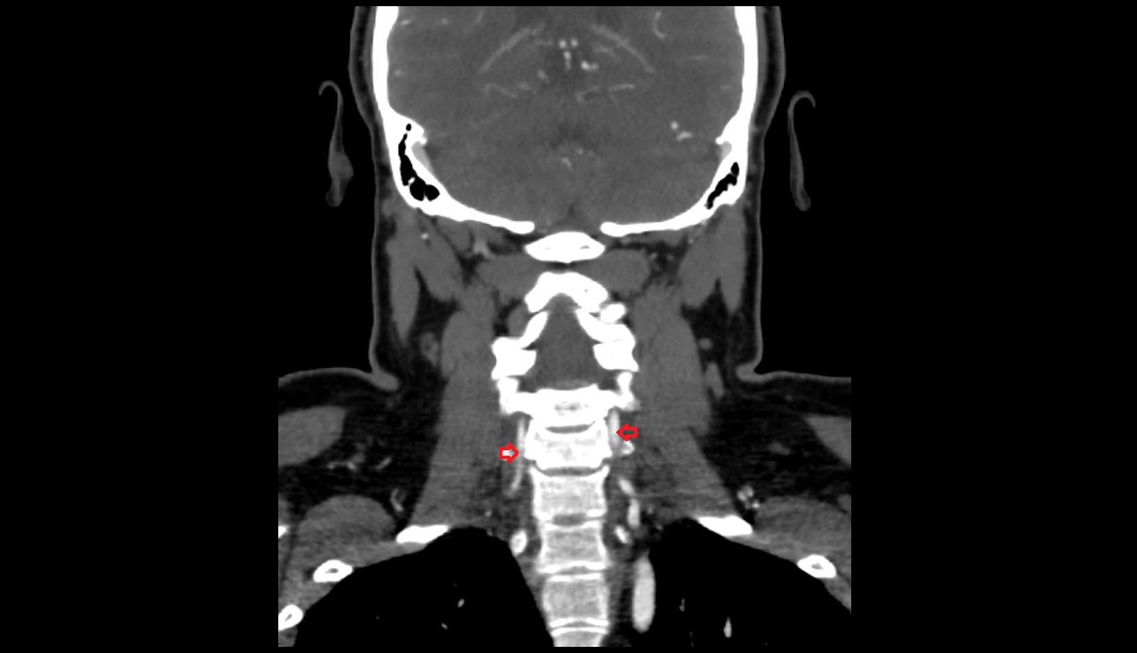 Vertebral artery CT CORONAL