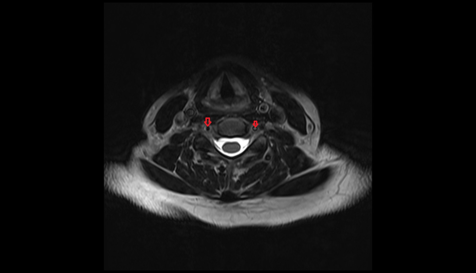 Vertebral artery MRI AXIAL
