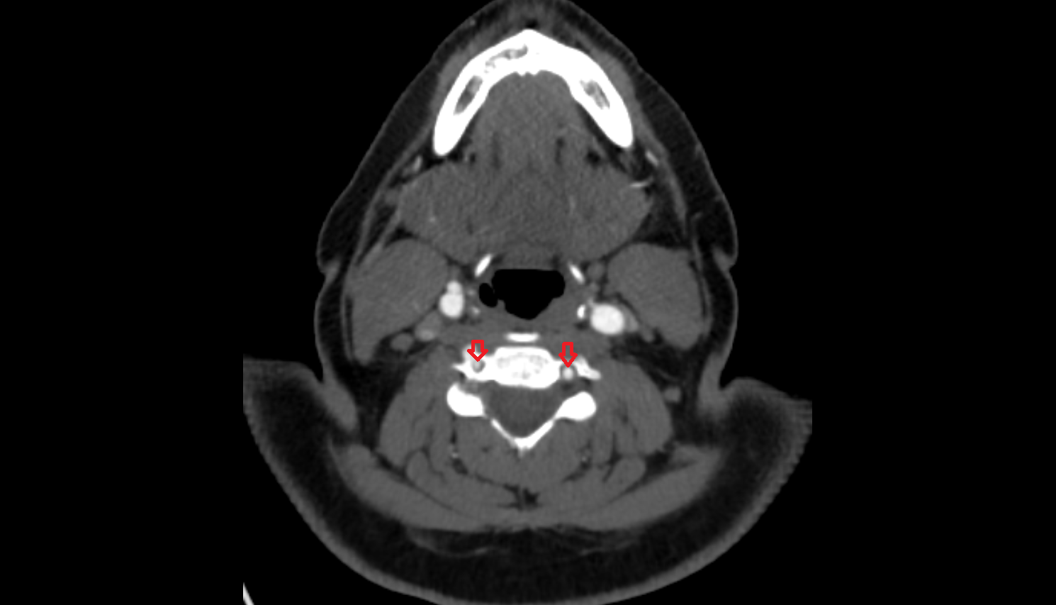 Vertebral artery (cervical part)  CT axial  image-img-00000-00000