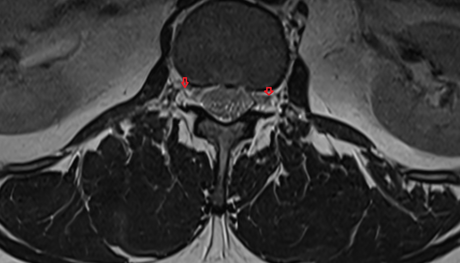 Vertebral venous plexus  mri axial  anatomy  image-img-00000-00000