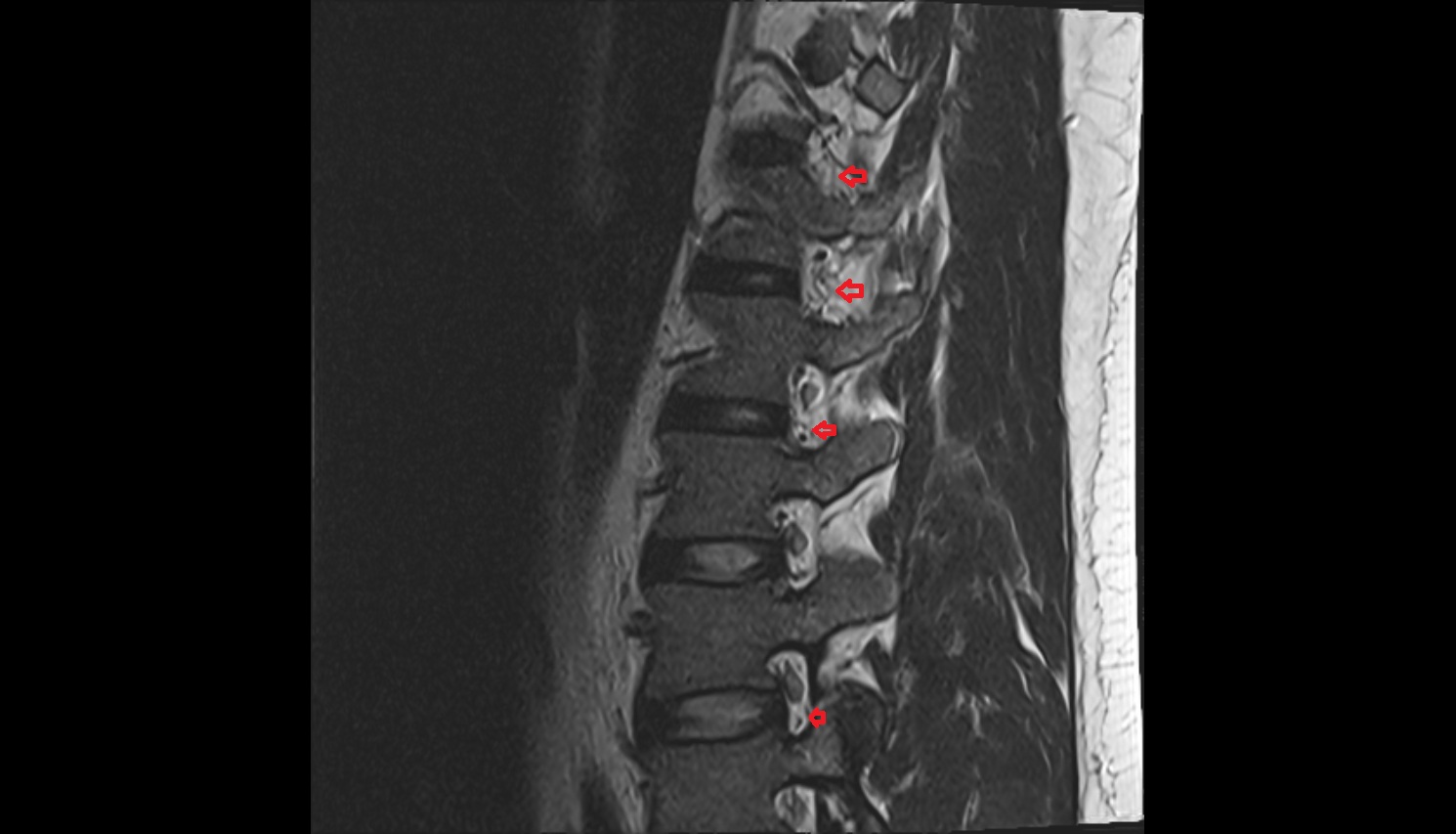 Vertebral venous plexus  mri sag  anatomy  image-img-00000-00000
