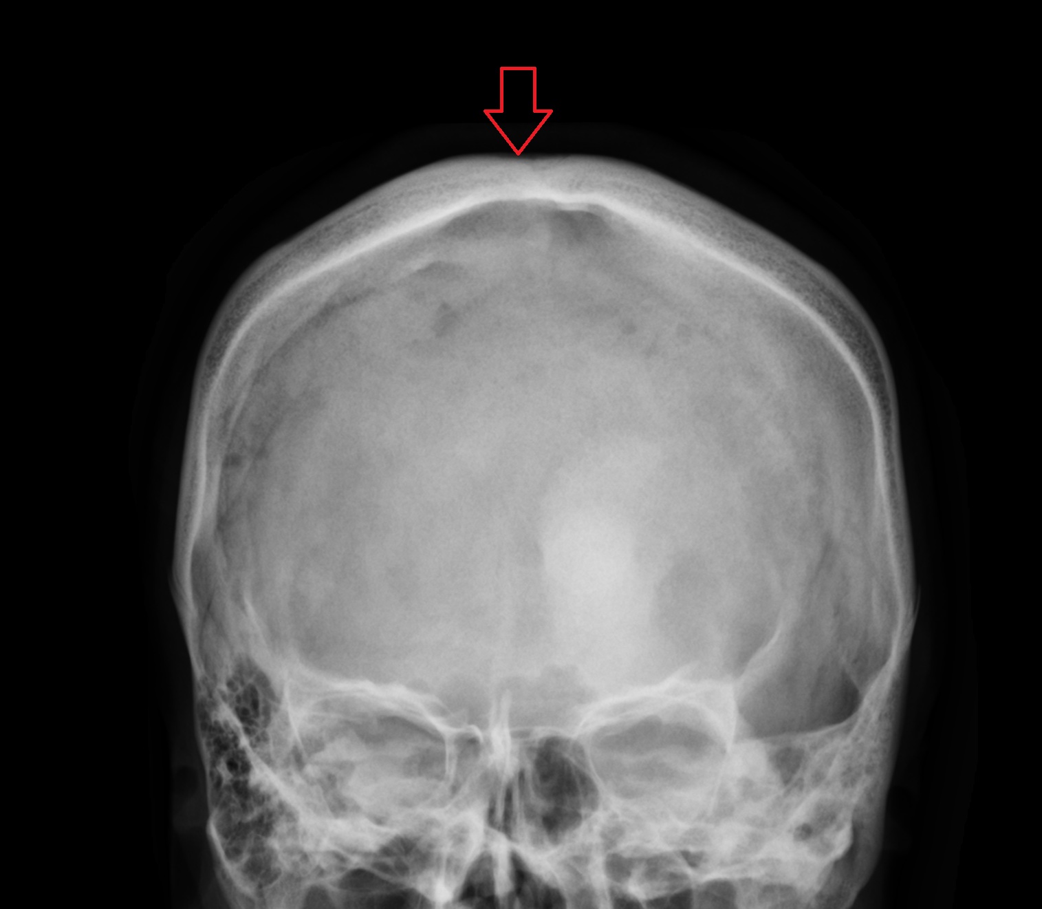 Vertex X RAY ANATOMY IMAGE