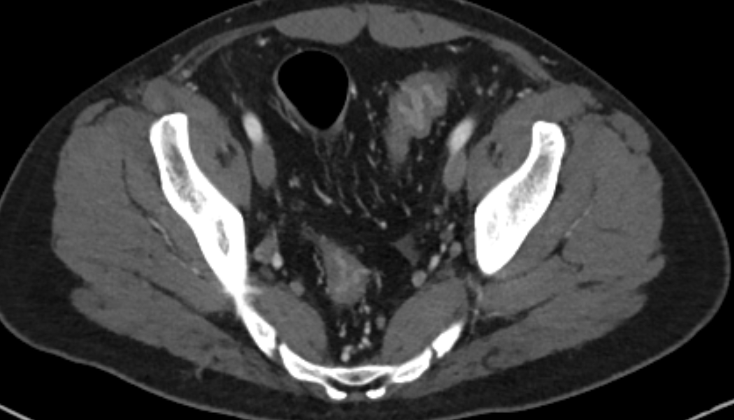 Vesical veins  CT axial  anatomy  image-img-00000-00000