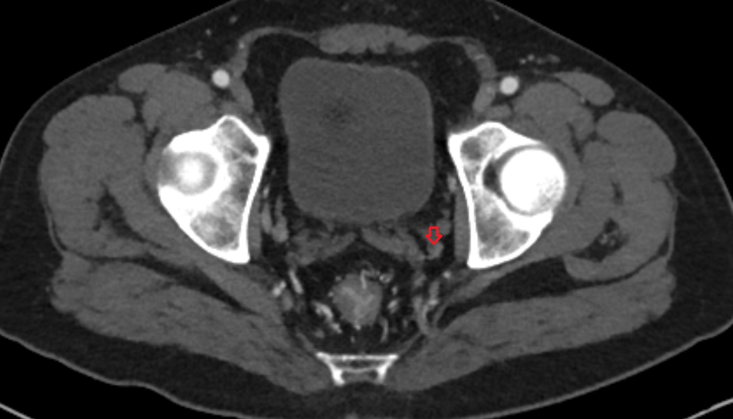 Vesical veins  CT axial  anatomy  image-img-00000-00000_00001