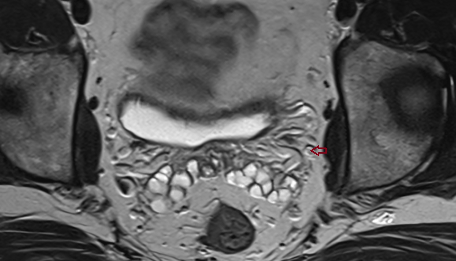 Vesical veins  mri axial  anatomy  image-img-00000-00000_00001