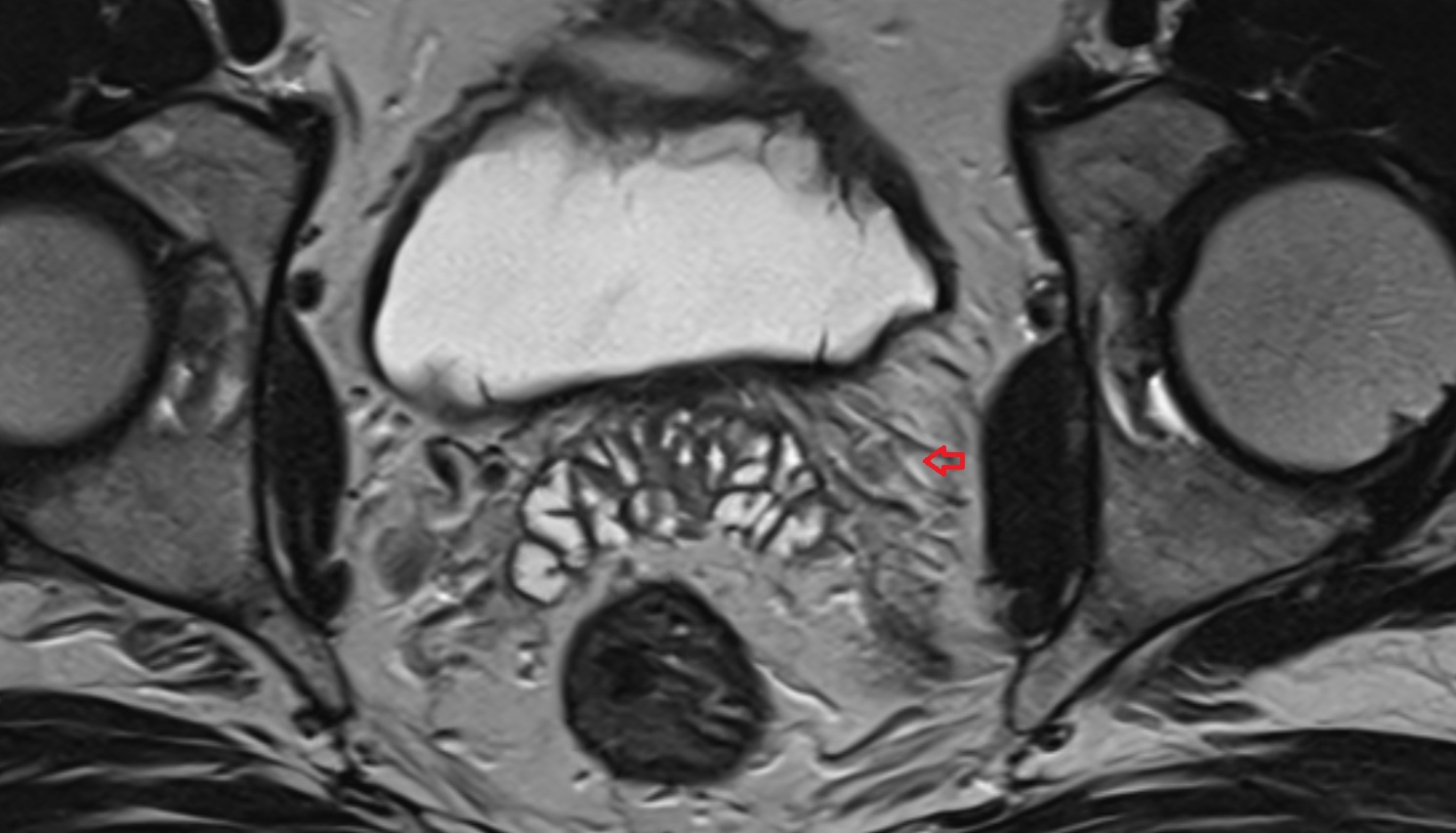 Vesical veins  mri axial  anatomy  image-img-00000-00000_00002