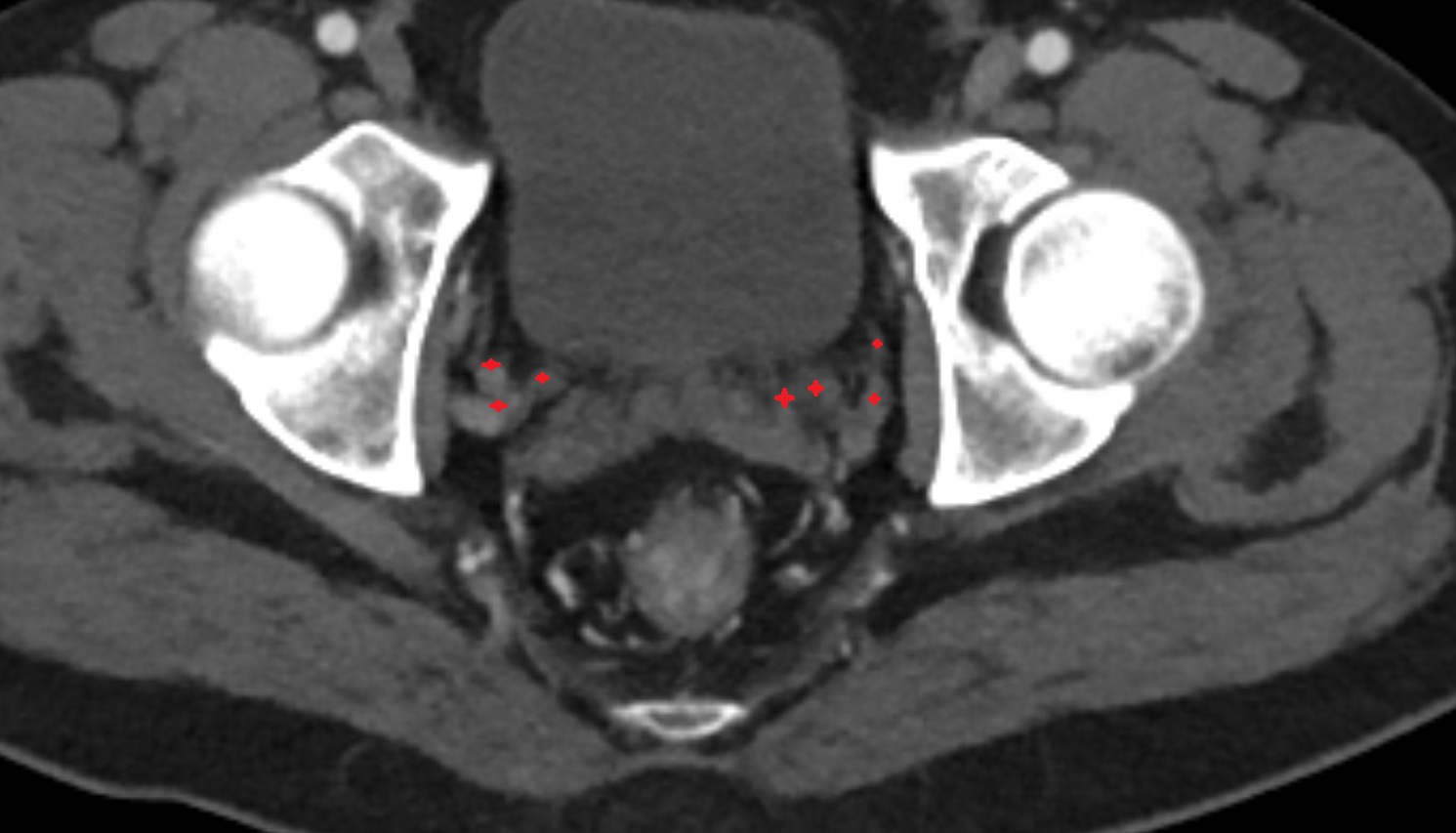 Vesical venous plexus   CT axial anatomy male