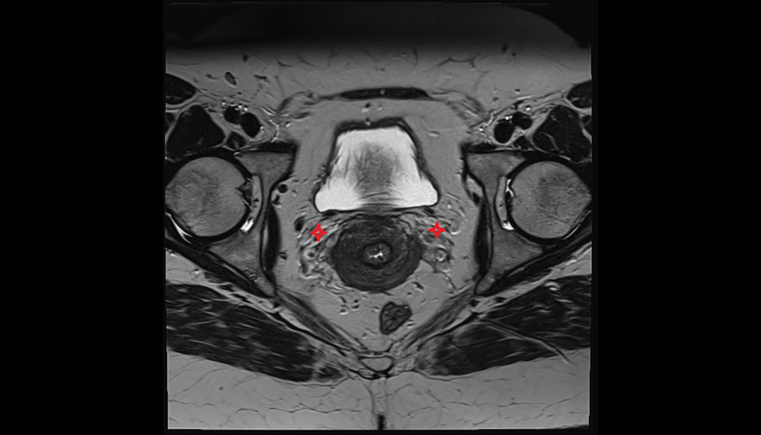 Vesical venous plexus   CT axial anatomy  female