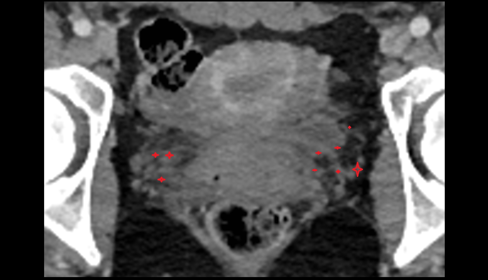 Vesical venous plexus female ct