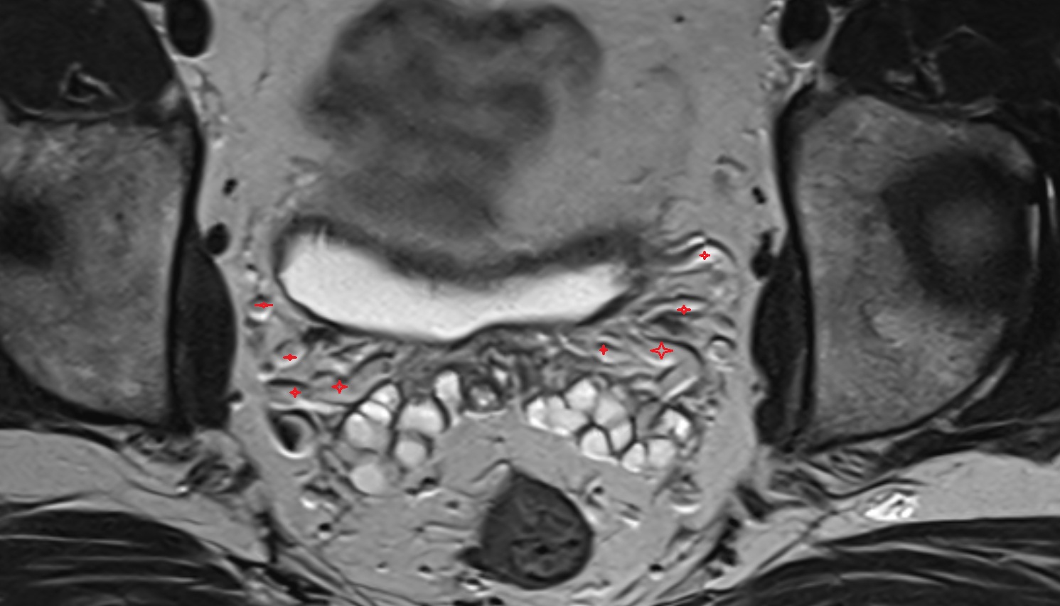 Vesical venous plexus  mri axial  anatomy  image-img-00000-00000