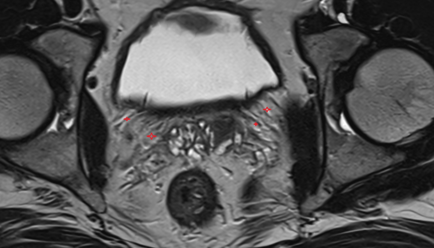 Vesical venous plexus  mri axial  anatomy  image-img-00000-00000_00001