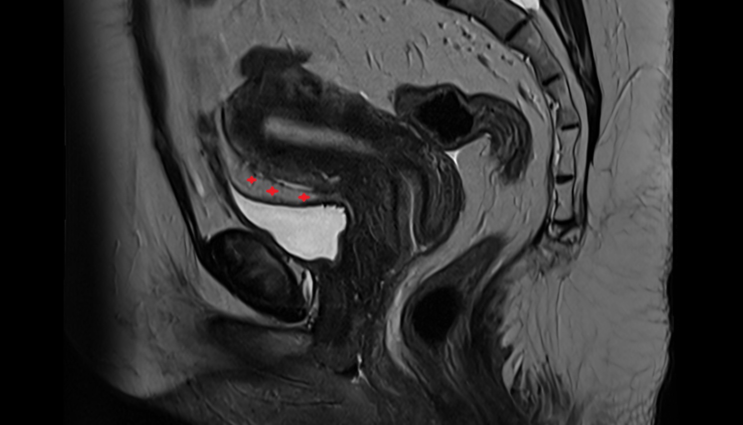 Vesicouterine pouch  MRI sagittal  anatomy  image-img-00000-00000