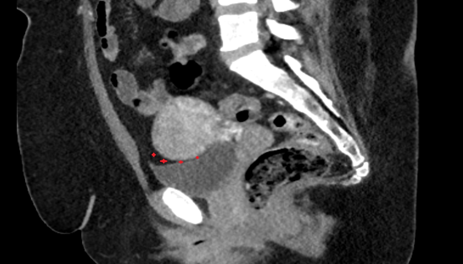 Vesicouterine pouch  ct  sagittal  anatomy  image-img-00000-00000