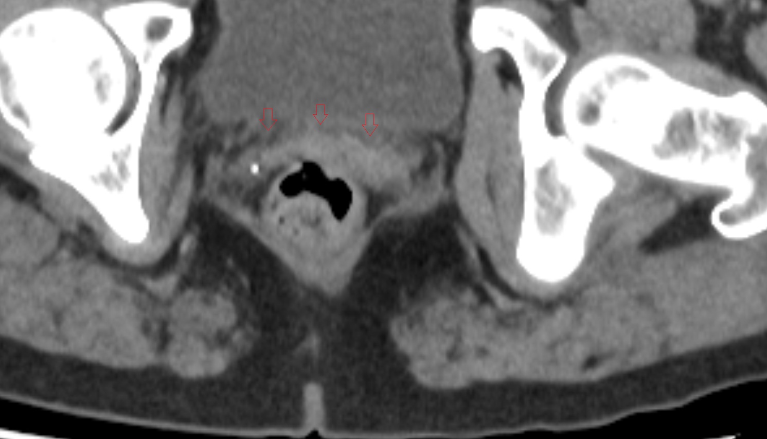 Vesicovaginal space  CT axial anatomy  image-img-00000-00000