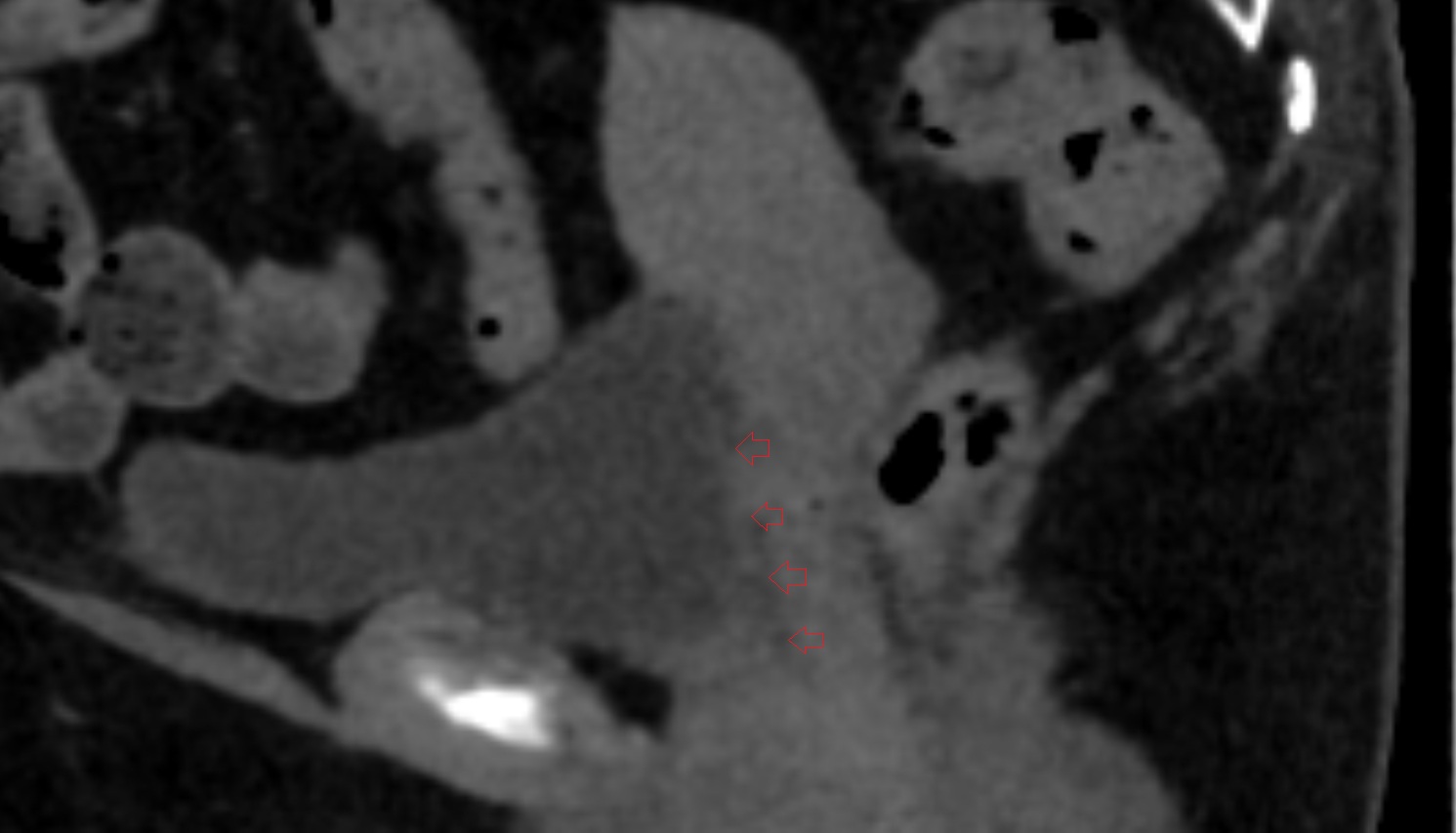 Vesicovaginal space  CT sagittal  anatomy  image-img-00000-00000