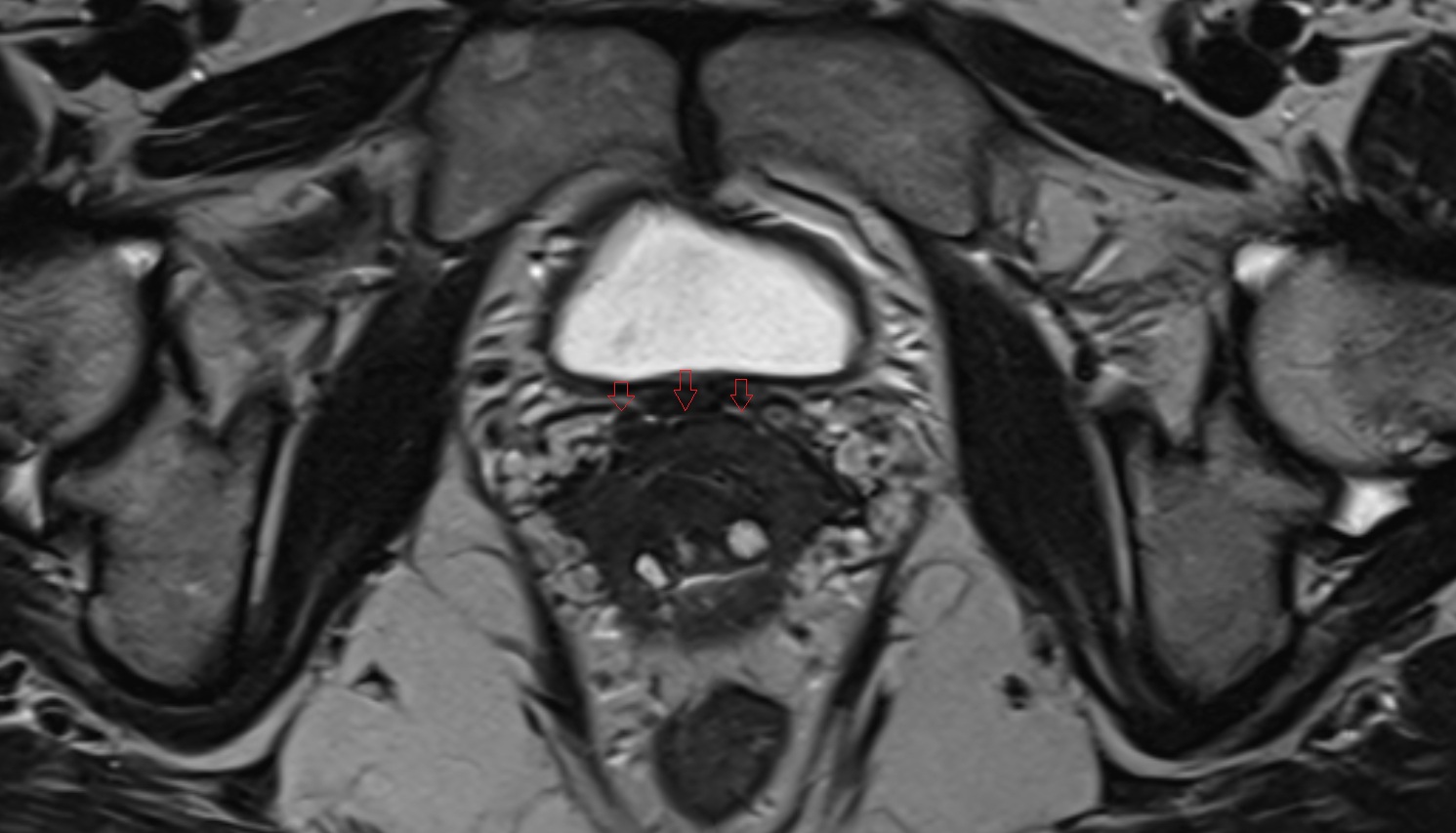Vesicovaginal space MRI axial anatomy  image-img-00000-00000