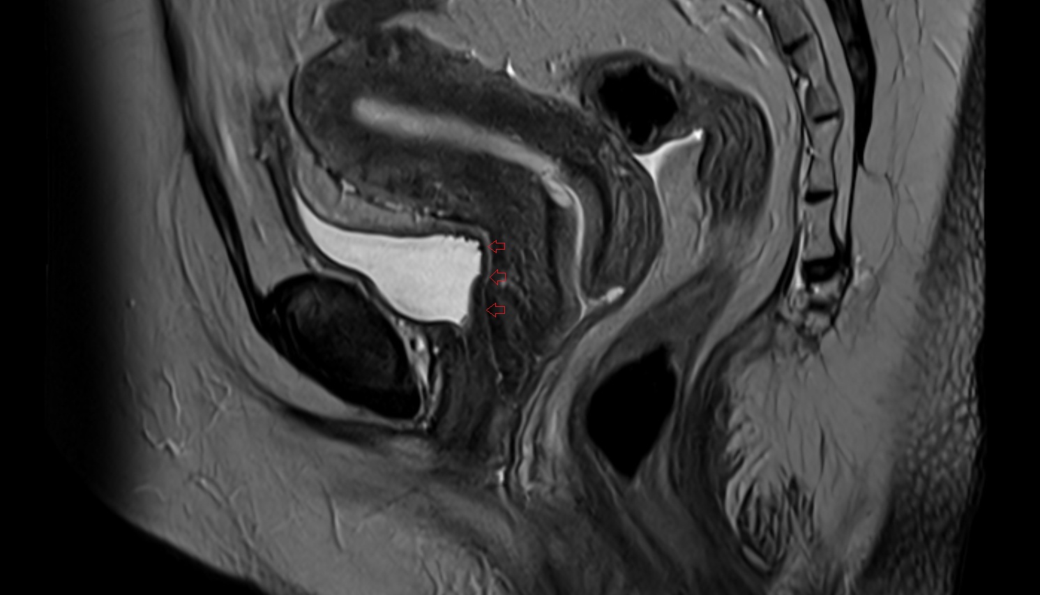 Vesicovaginal space MRI sagittal  anatomy  image-img-00000-00000