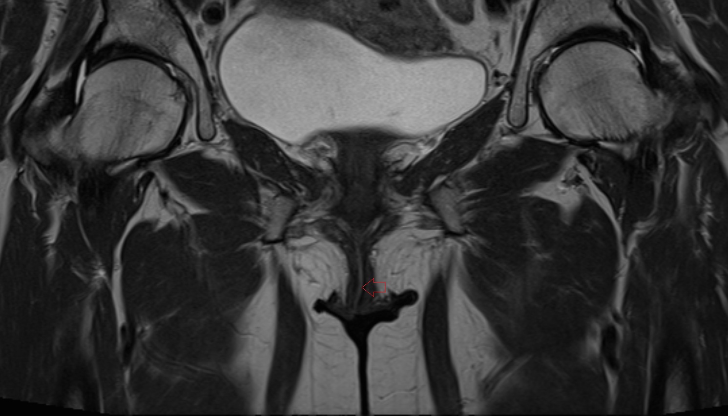 Vestibular fossa  MRI coronal anatomy  image-img-00000-00000