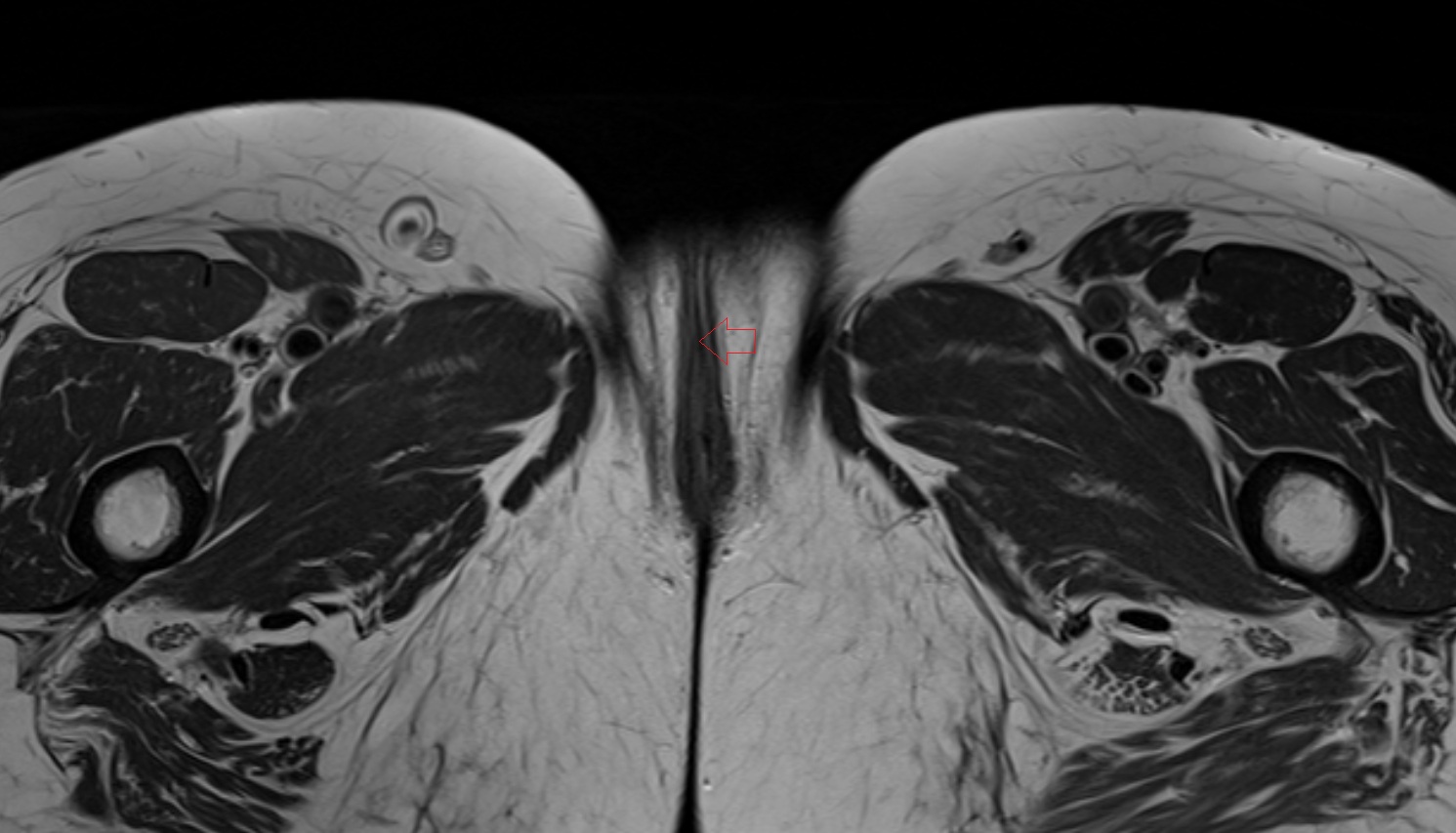 Vestibular fossa  MRI coronal anatomy  image-img-00000-00000_00001