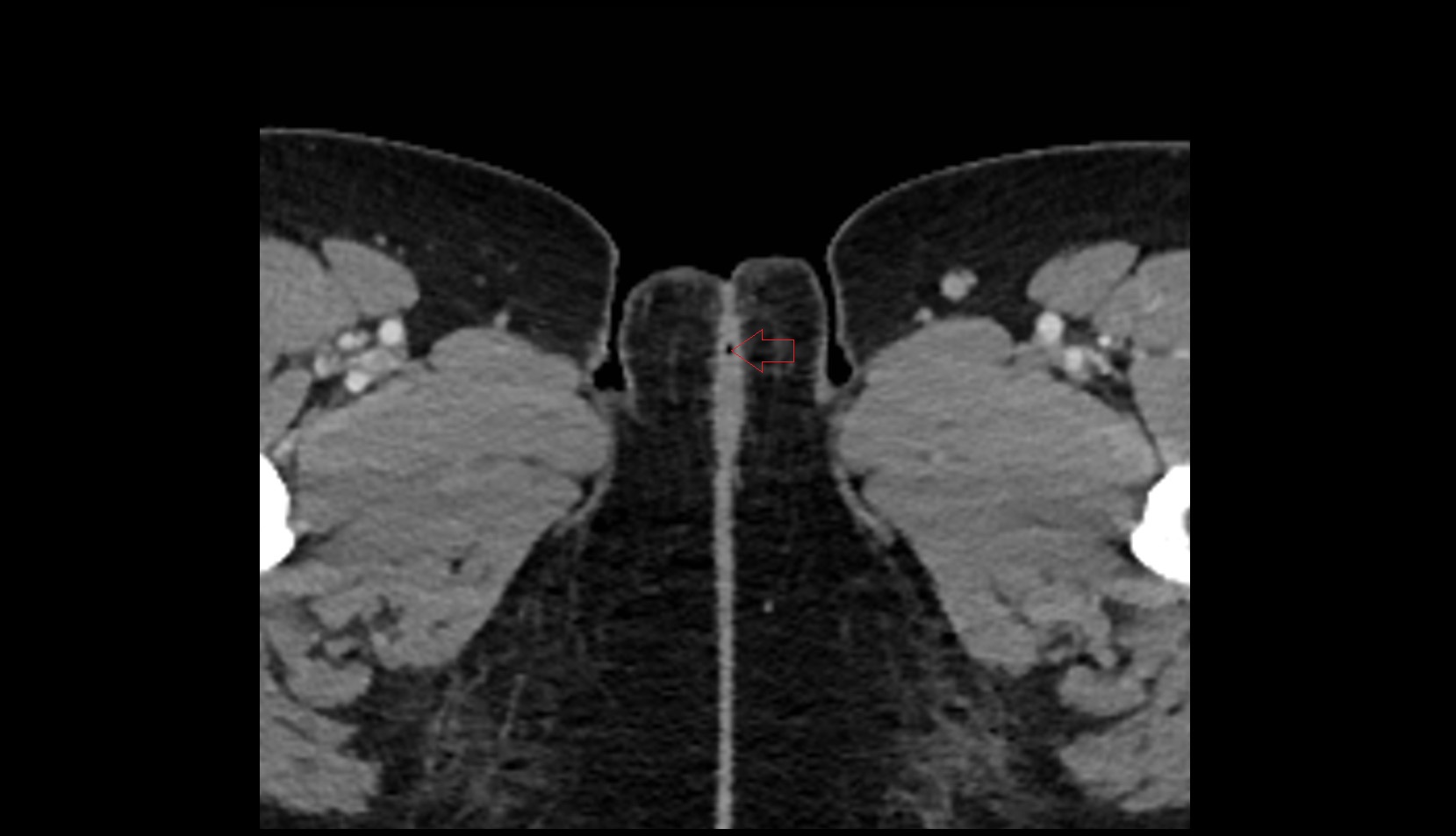 Vestibular fossa ct axial image