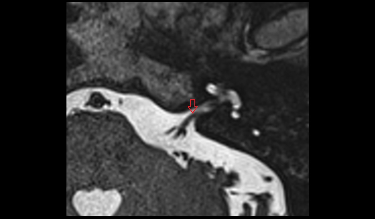 Vestibular ganglion MRI 3T axial image