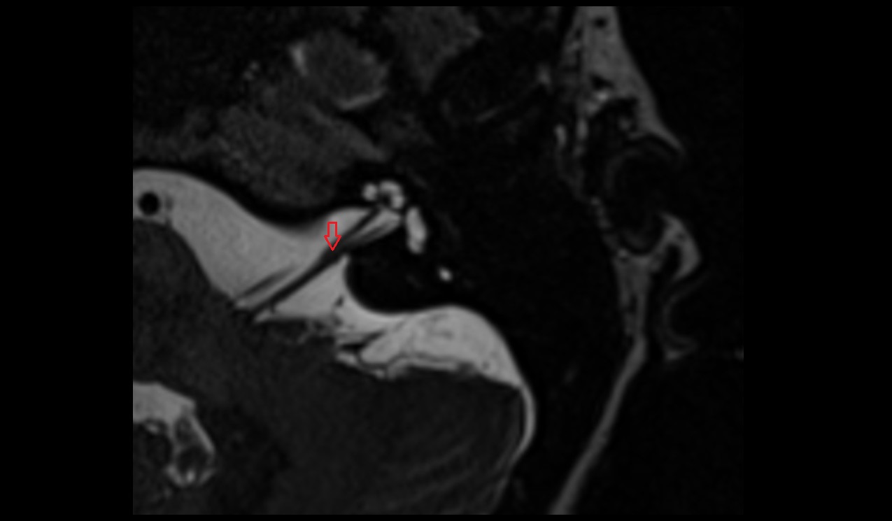 Vestibular ganglion MRI 3T axial image 1