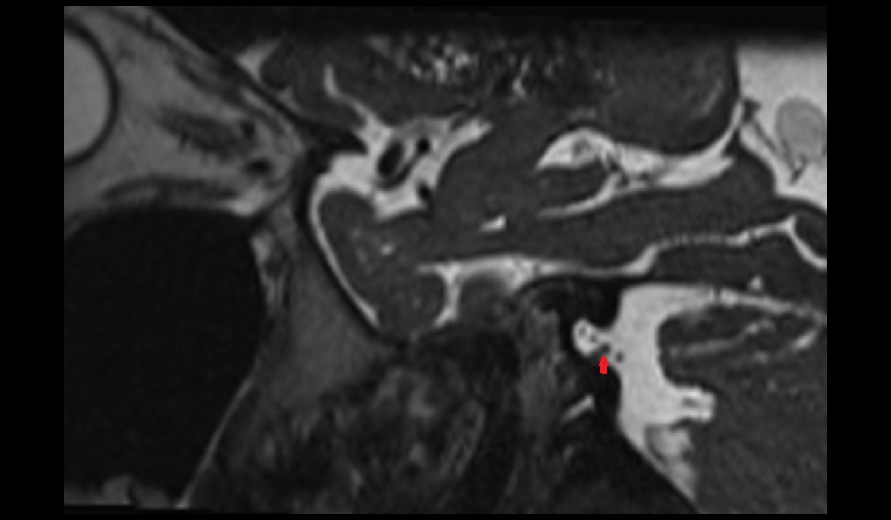 Vestibular ganglion MRI 3T sagittall image