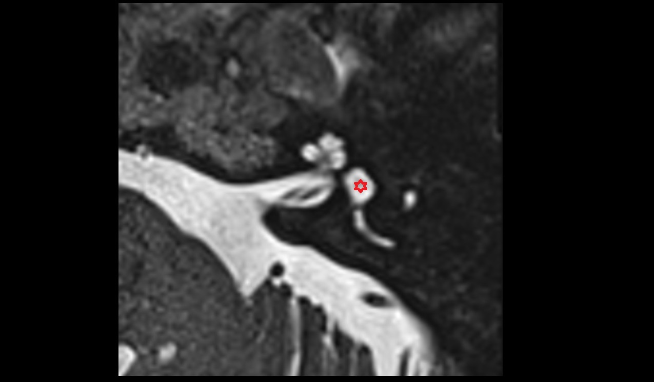 Vestibule MRI 3T axial image