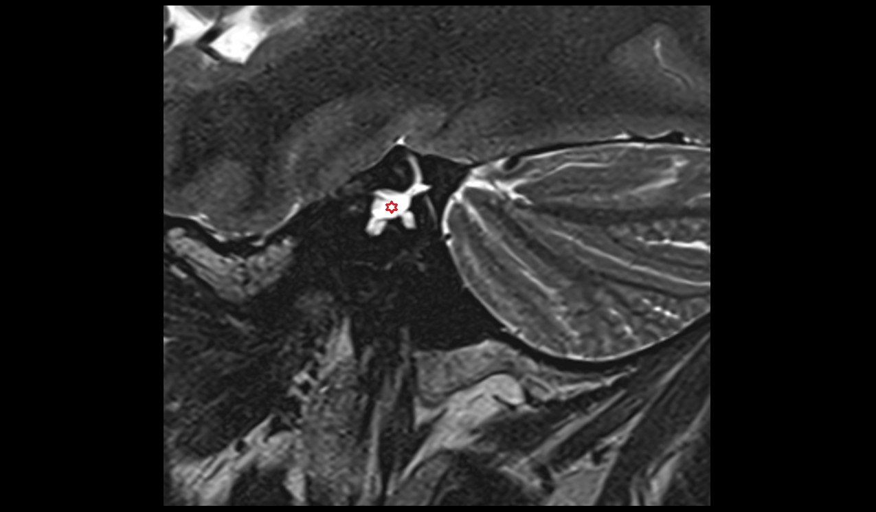 Vestibule MRI 3T sagittal  image