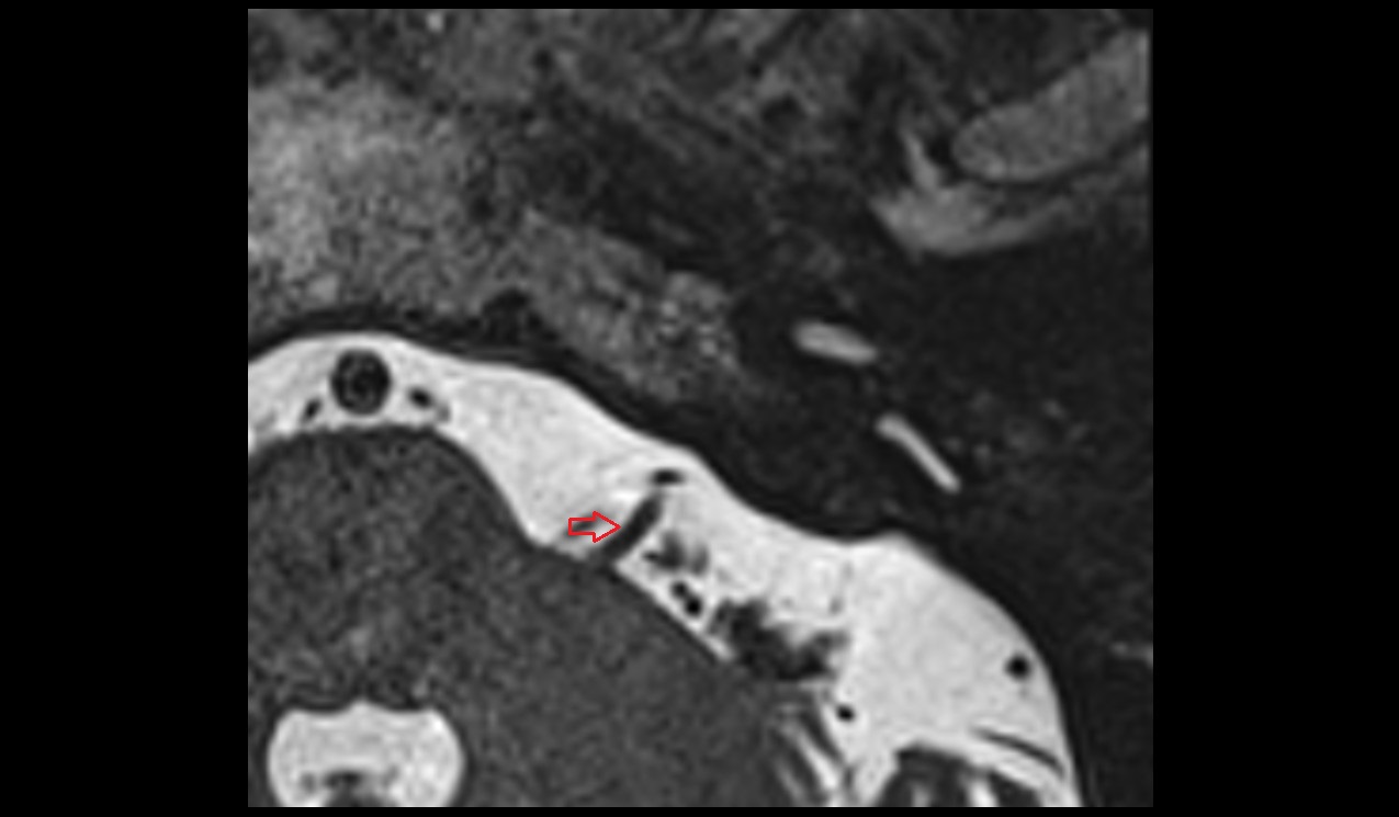 Vestibulocochlear nerve (Cranial nerve VIII) MRI 3T axial image