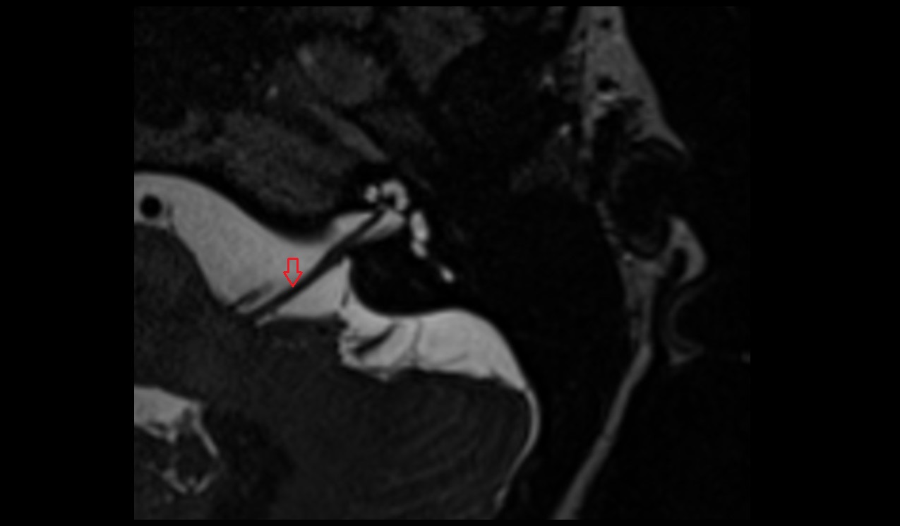 Vestibulocochlear nerve (Cranial nerve VIII) MRI 3T axial image1