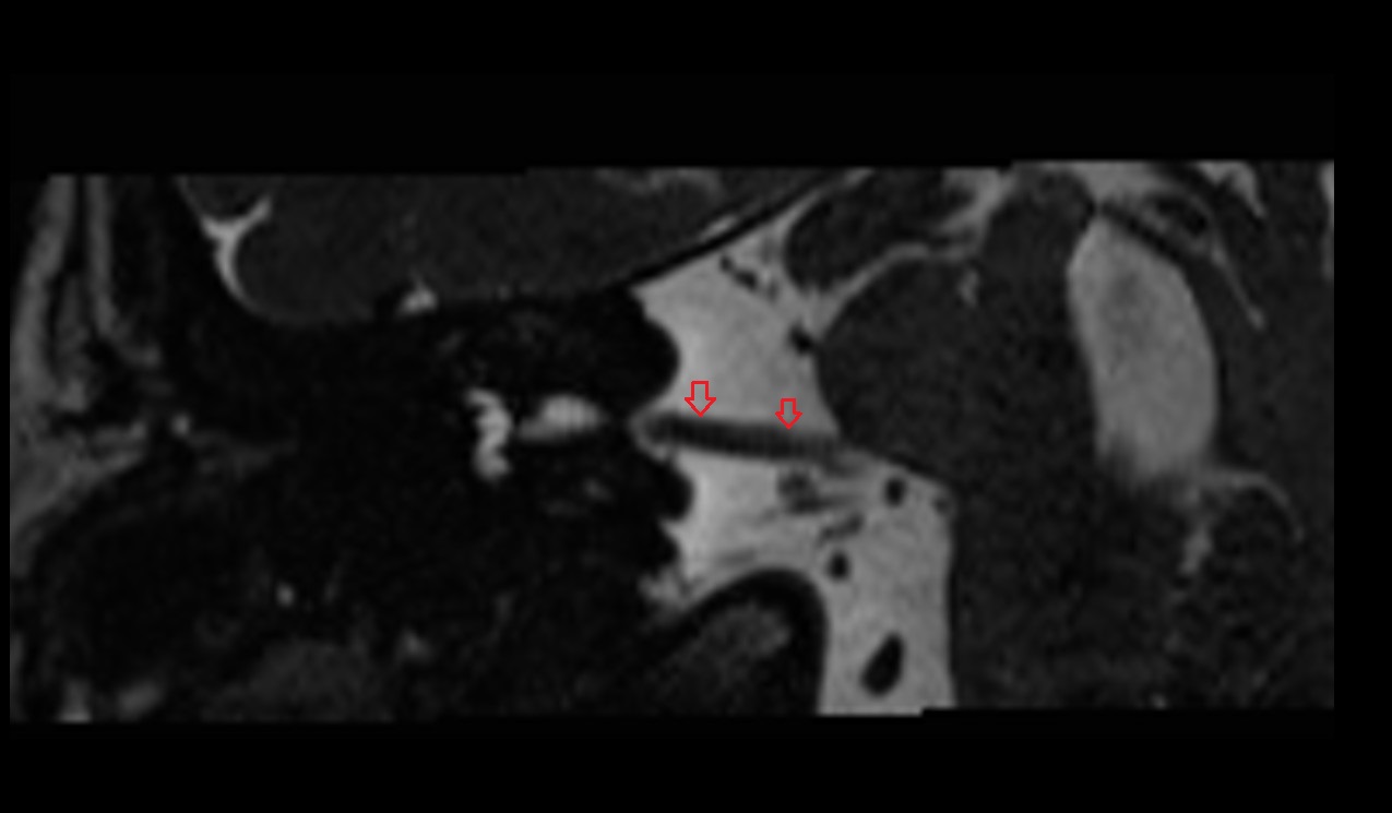Vestibulocochlear nerve (Cranial nerve VIII) MRI 3T coronal image