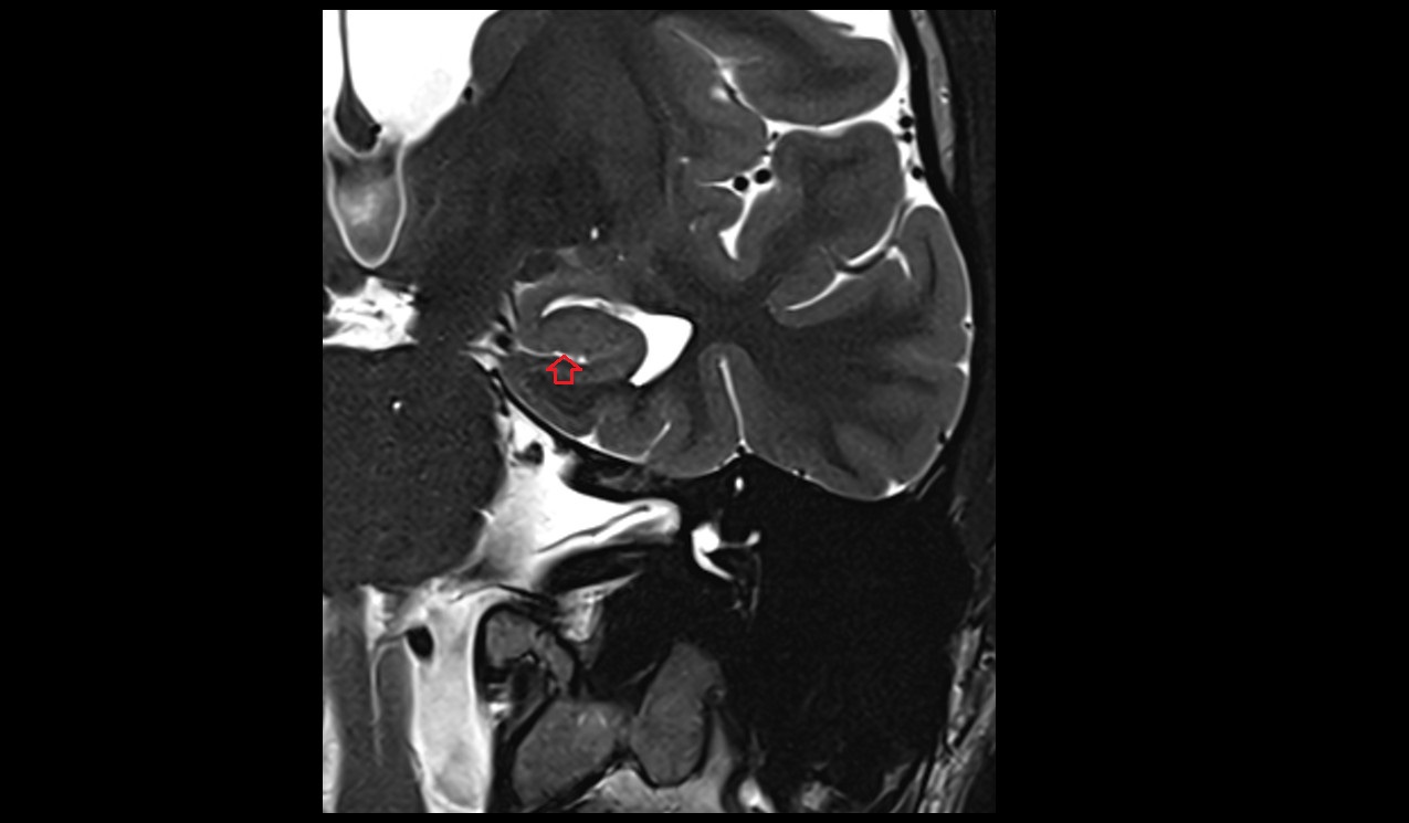 Vestigial hippocampal sulcus mri 3t coronal image