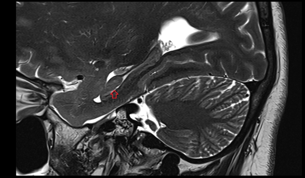 Vestigial hippocampal sulcus mri 3t sagittal image
