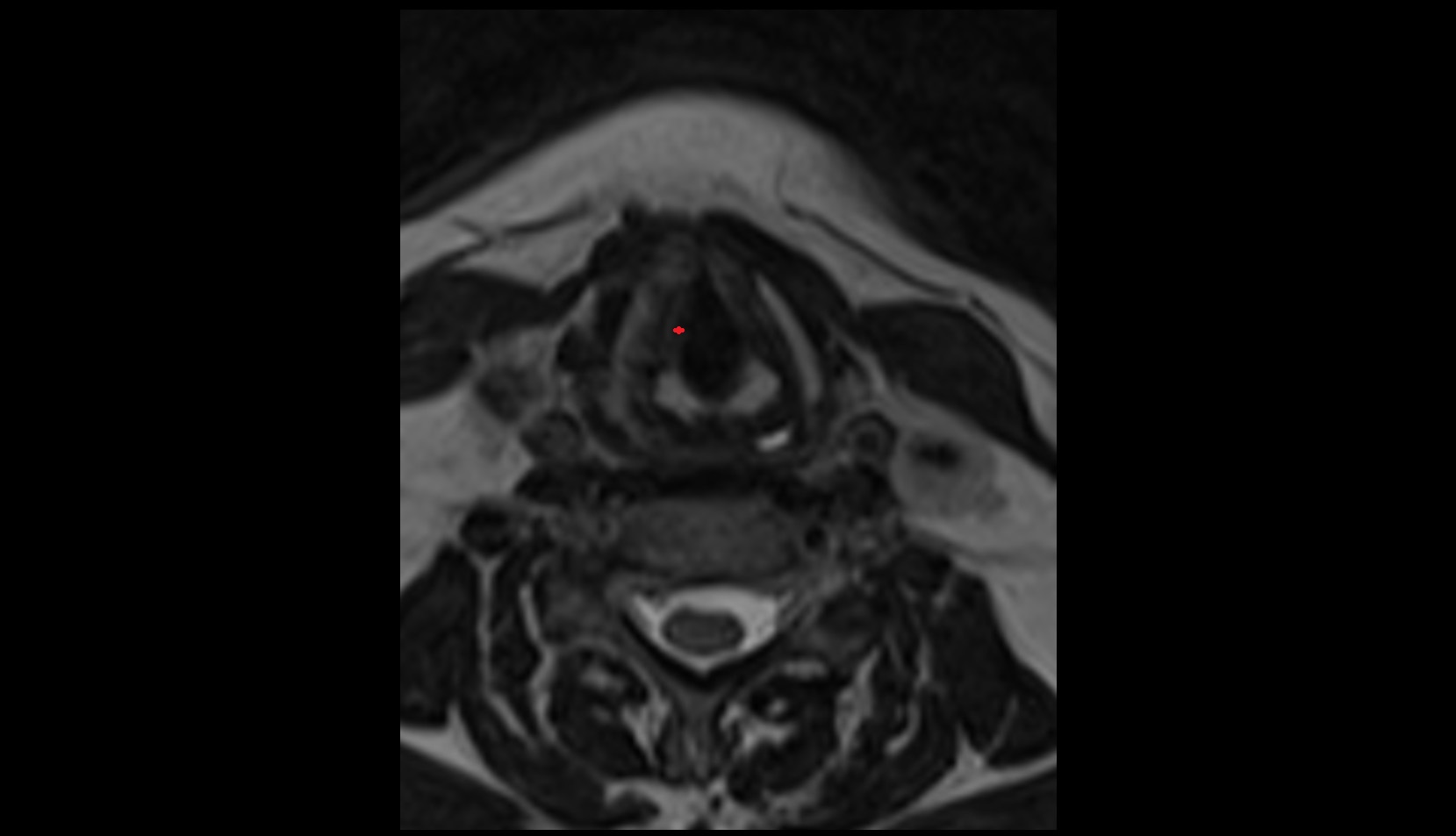 Vocalis muscle MRI AXIAL IMAGE