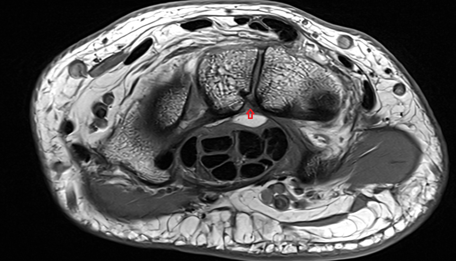 Volar capitohamate ligament  axial cross sectional anatomy 3T MRI AI enhanced radiology image-img-00000-00000