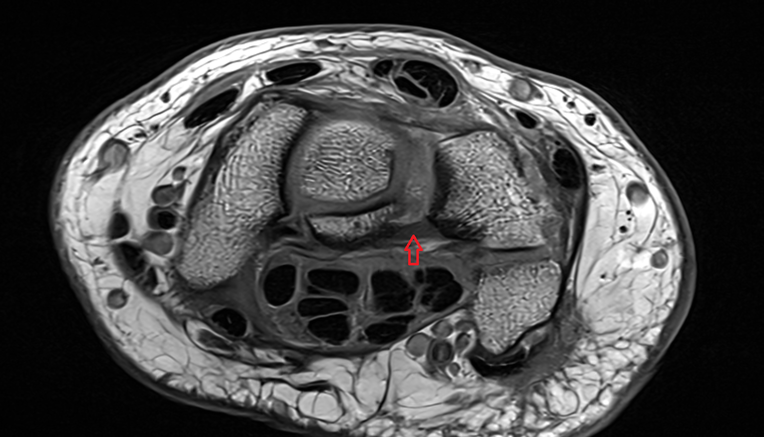Volar lunotriquetral ligament axial cross sectional anatomy 3T MRI AI enhanced radiology image-img-00000-00000