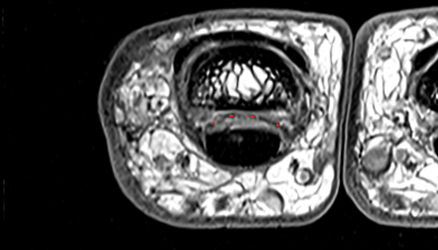 Volar plate hand  MRI axial  image-img-00000-00000