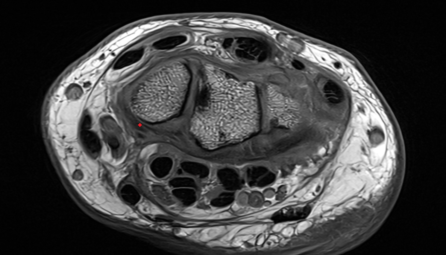 Volar radioscaphocapitate ligament axial cross sectional anatomy 3T MRI AI enhanced radiology image-img-00000-00000