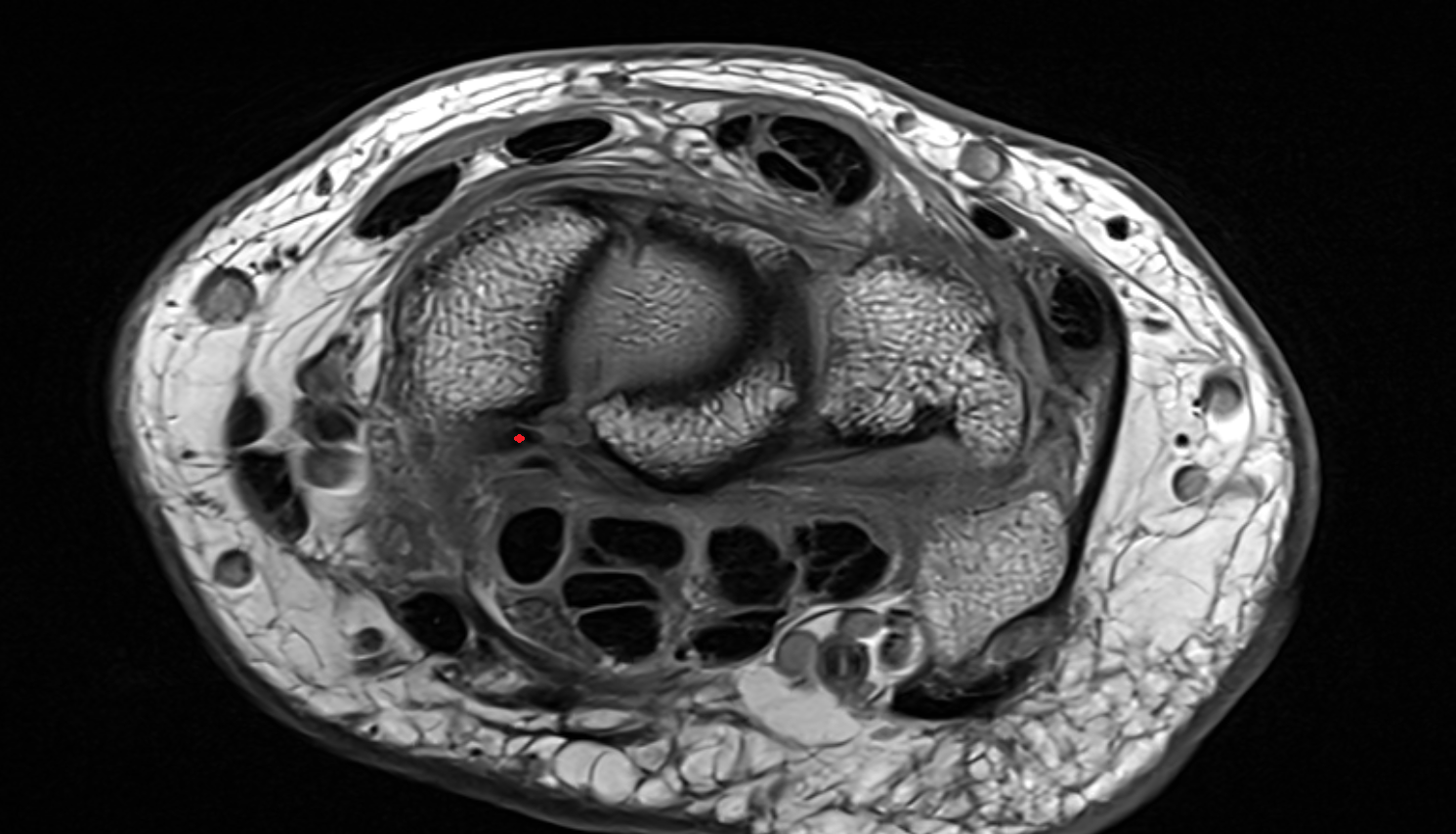 Volar radioscaphocapitate ligament axial cross sectional anatomy 3T MRI AI enhanced radiology image-img-00000-00000_00001