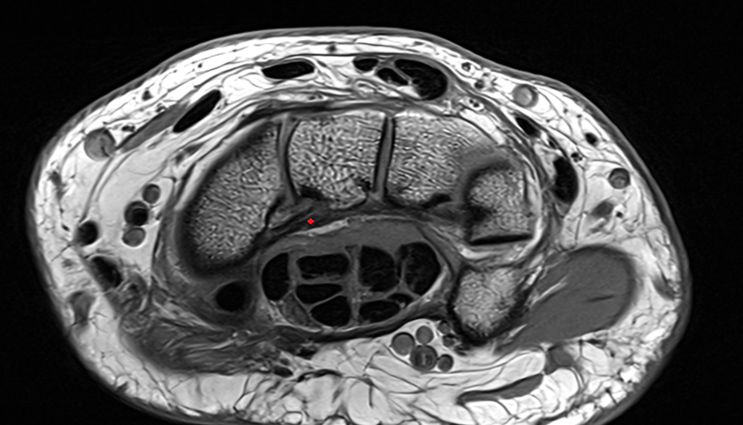 Volar radioscaphocapitate ligament axial cross sectional anatomy 3T MRI AI enhanced radiology image-img-00000-00000_00002