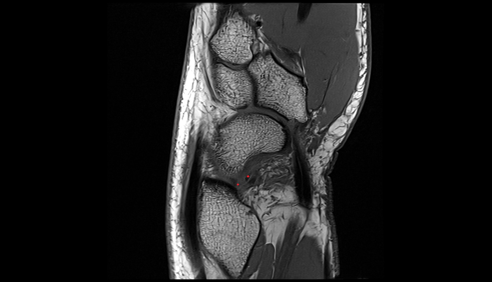 Volar radioscaphocapitate ligament mri sagittal image 1