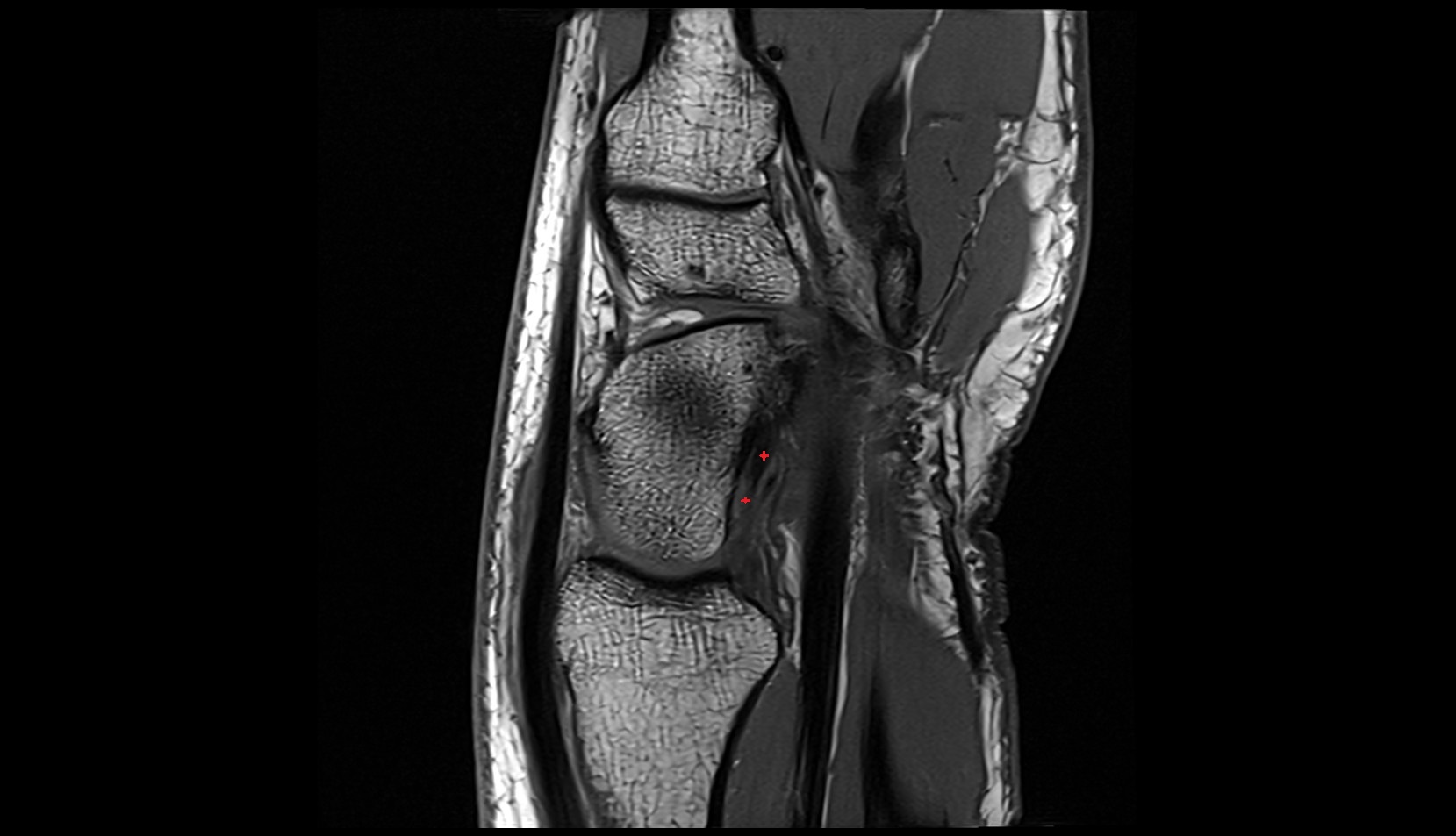 Volar radioscaphocapitate ligament mri sagittal image 2
