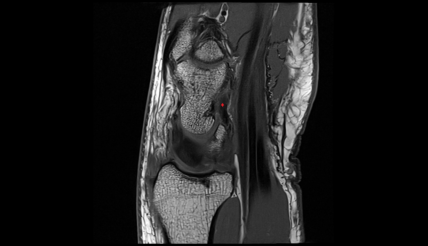 Volar radioscaphocapitate ligament mri sagittal image 3
