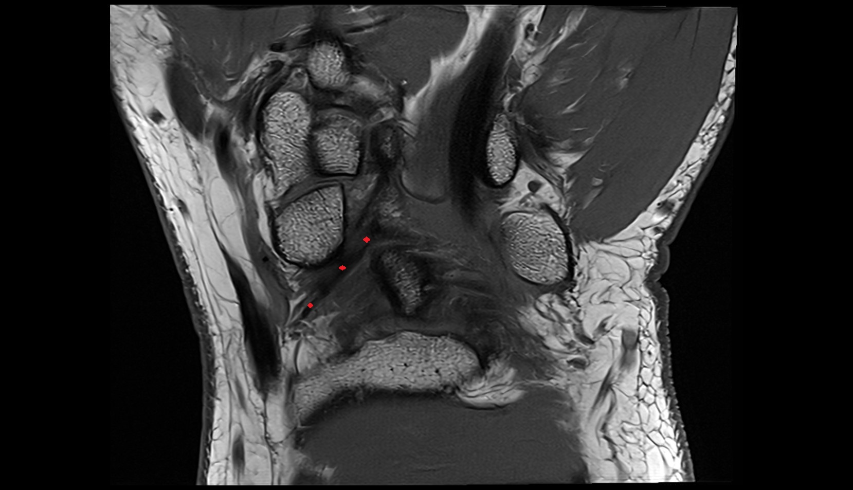 Volar radioscaphocapitate ligament mri sagittal image  coronal mri image