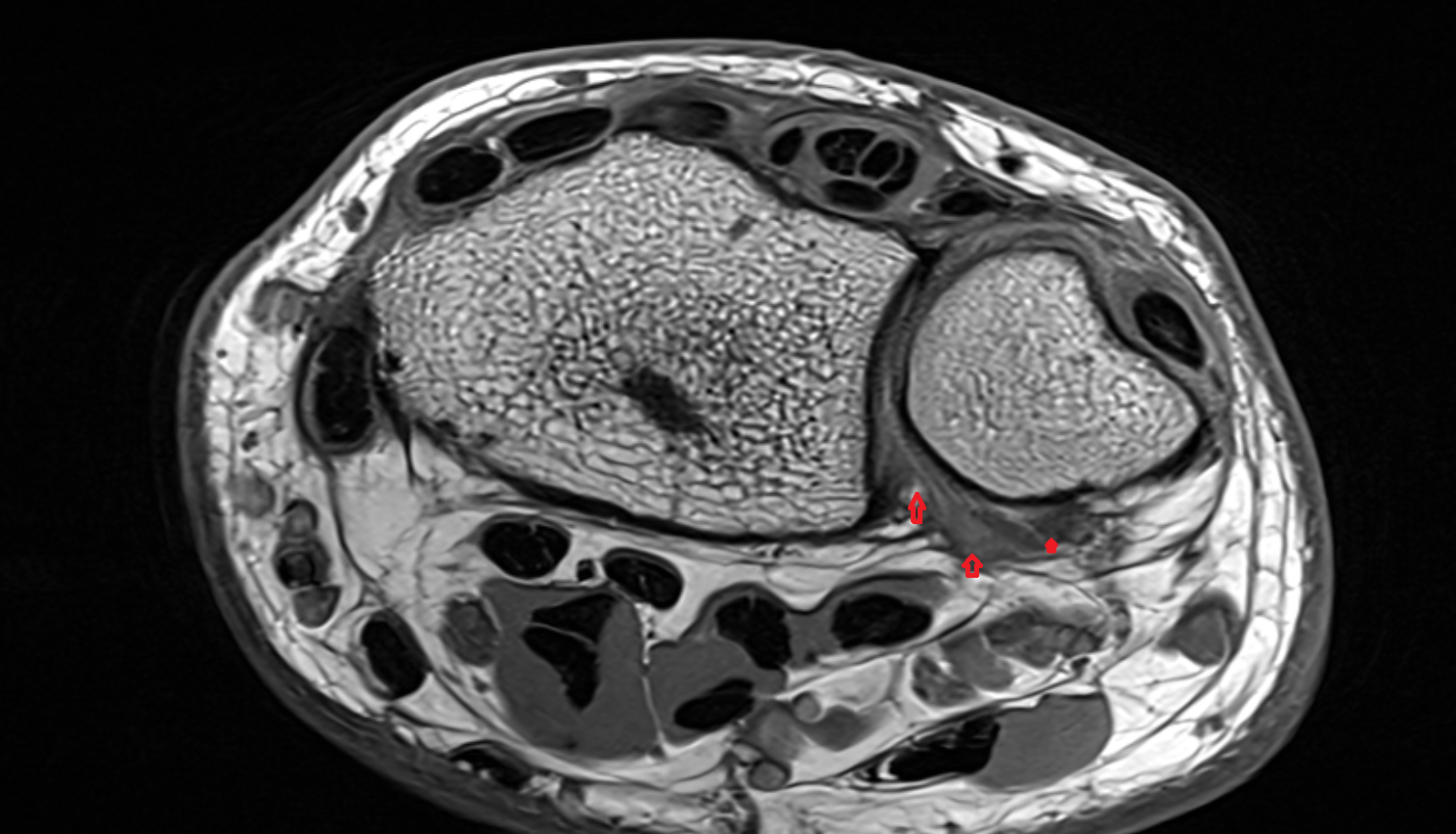 Volar radioulnar ligament axial cross sectional anatomy 3T MRI AI enhanced radiology image-img-00000-00000