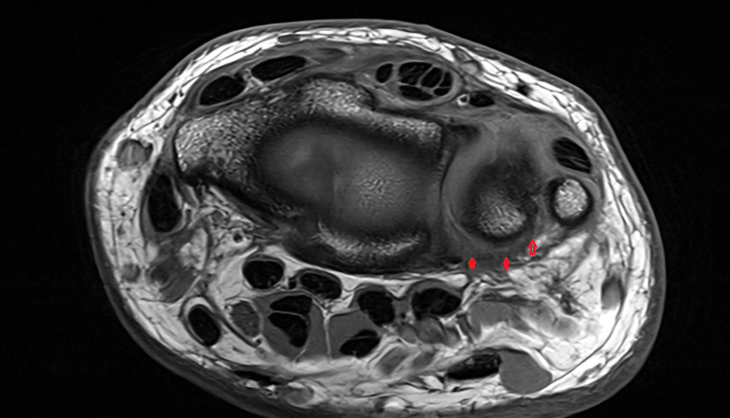 Volar radioulnar ligament axial cross sectional anatomy 3T MRI AI enhanced radiology image-img-00000-00000_00001
