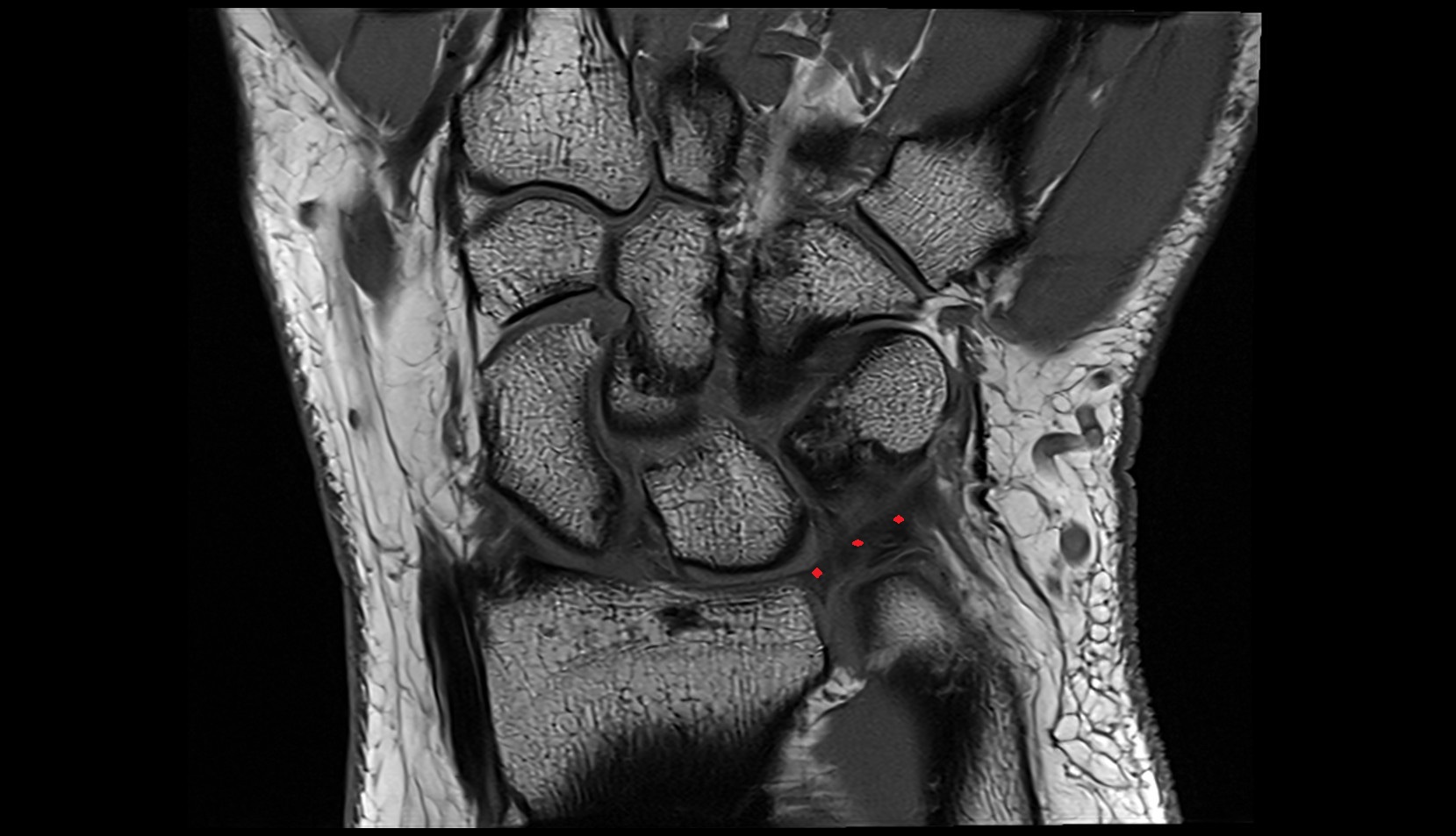 Volar radioulnar ligament mri coronal image