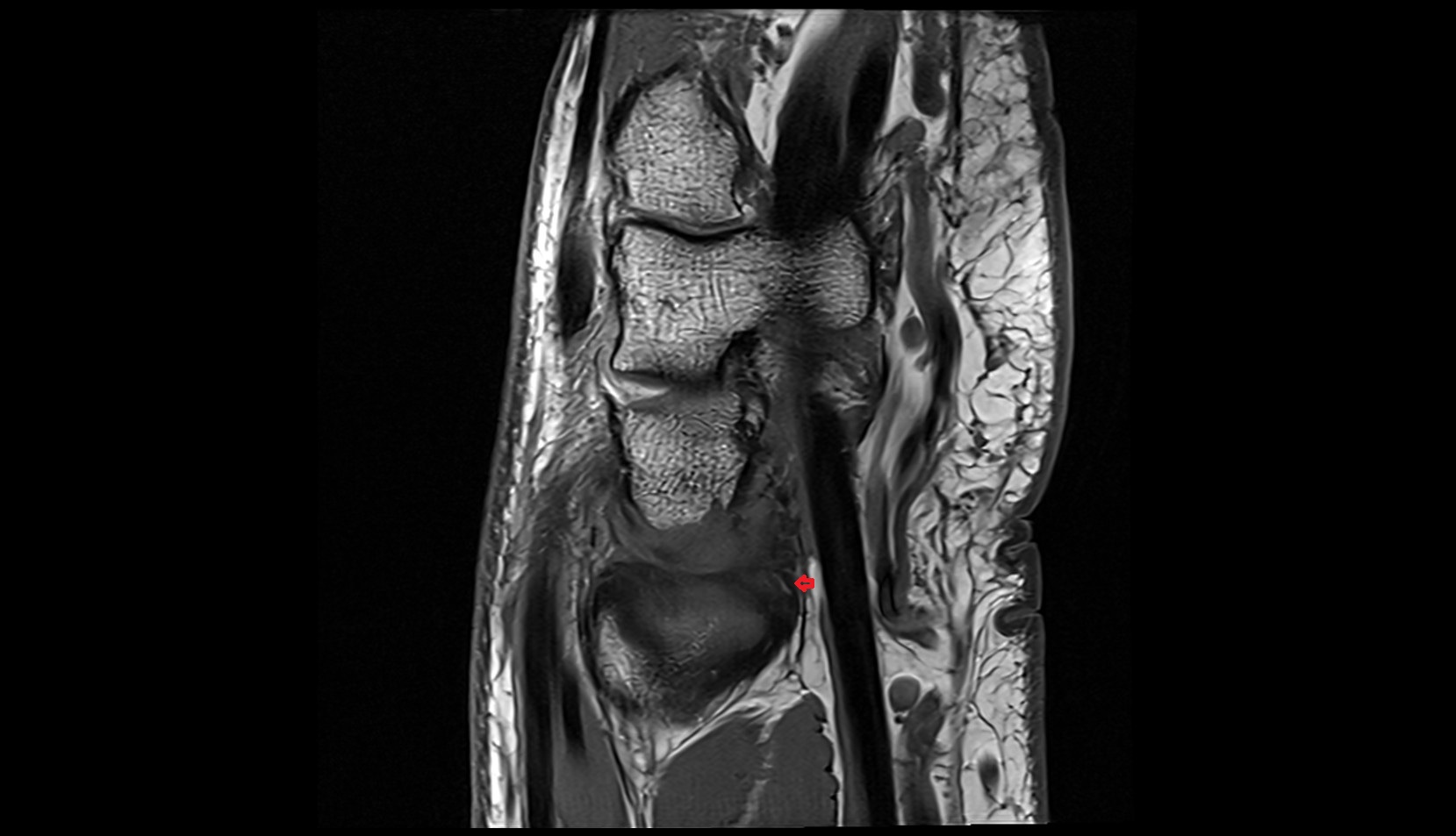 Volar radioulnar ligament mri sagitta image